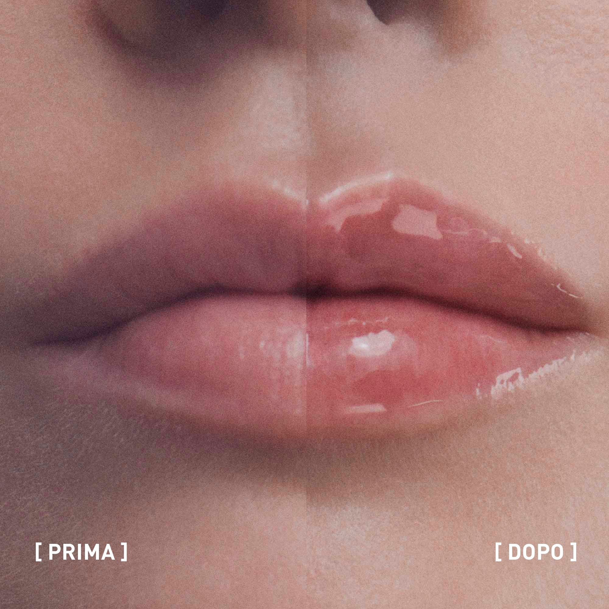 HYALU-FILLER LIPS - Image 3